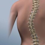 What Happens During Scoliosis Treatment for Adults?