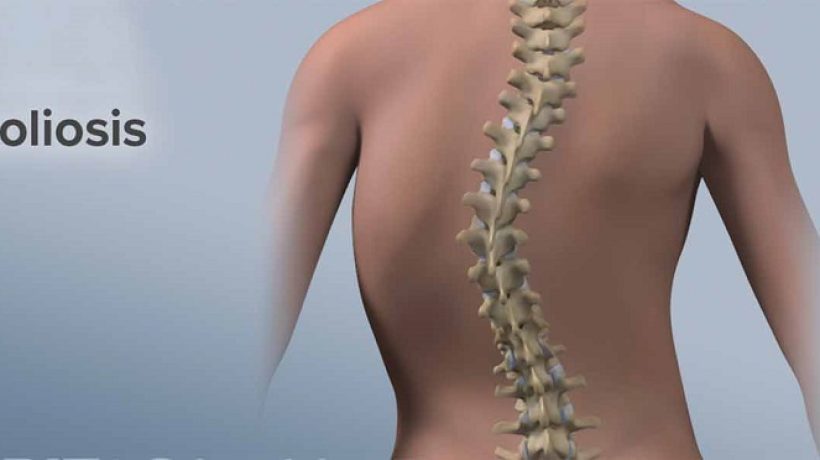What Happens During Scoliosis Treatment for Adults?